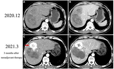 Primary hepatic malignant triton tumor mimicking hepatocellular carcinoma by demonstrating arterial-phase hypervascularity and subsequent washout on dynamic contrast-enhanced imaging: a case report and literature review